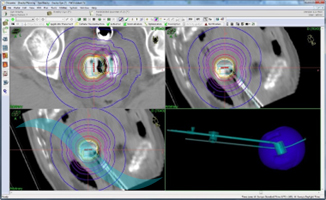 سیستم طراحی درمان Oncentra